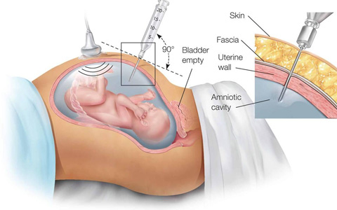 Ginekološka Ordinacija - Trion Medical - Amniocenteza