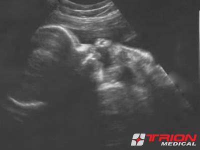 Ginekološka Ordinacija - Trion Medical - Savremeno praćenje trudnoće